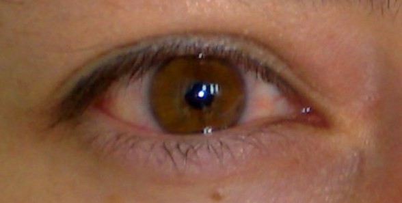 Infiammazione oculare